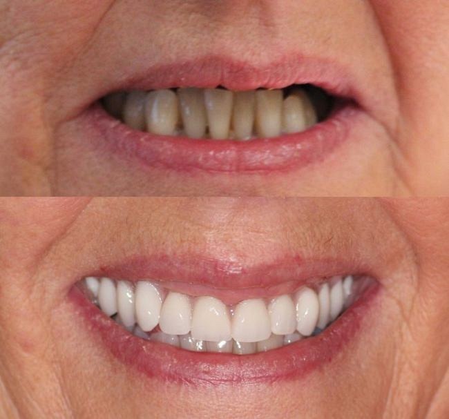 Removable Dentures Oakland OR 97462